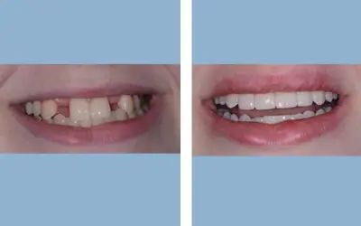 Before and After
